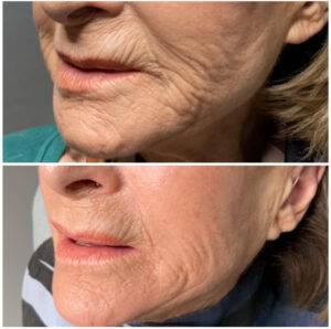 Procell Therapies Microchanneling for Skin Rejuvenation