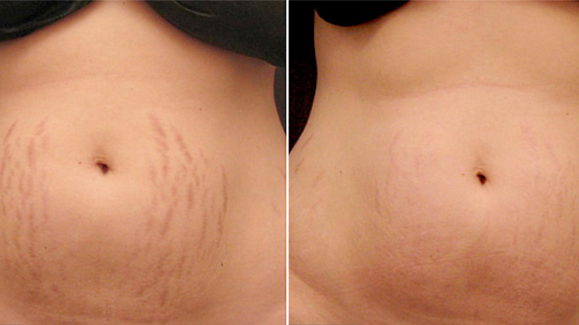 Stretchmark Scar Revision